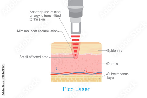 Pico laser working on skin layer by shorter pulse of energy is transmitted to the skin make small effect area. Mimimal heat accumulation.