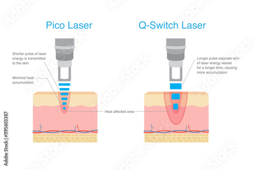 Area of Pico laser pulse effected with skin layer and Q switch laser. Difference of treatment with laser ray type. Dermatology Technology for Removal dark spot and scar.