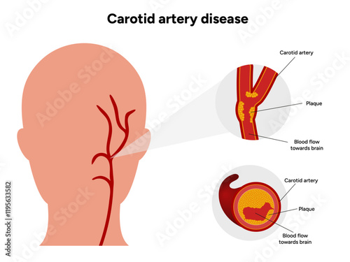 Carotid artery disease Signs of Carotid Artery Disease medical illustration diagram