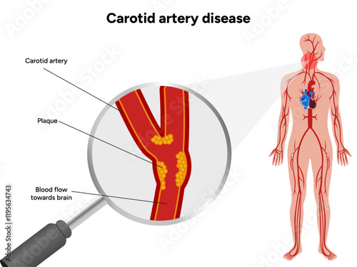 Carotid artery disease Signs of Carotid Artery Disease medical illustration diagram