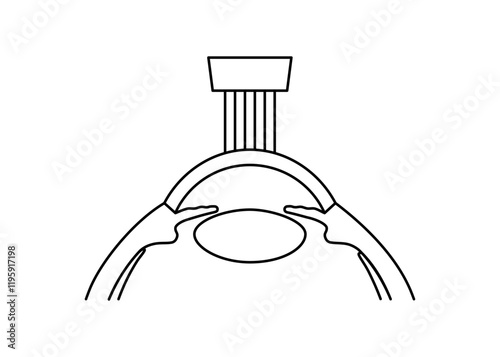 LASIK eye surgery