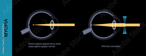 Myopia lens correction