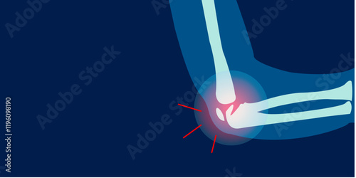 X-ray image of elbow pain ilustration. 2D Picture rontgen of Elbow bone in painful injury damage. Vector illustration.