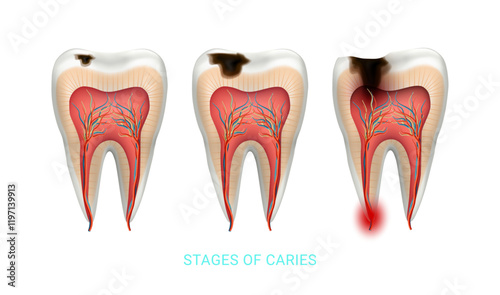 Stages of caries development in human molar. Vector isolated unhealthy tooth with dark, decayed area on occlusal surface with visible pits and holes. Dental diseases, cavities and periodontitis
