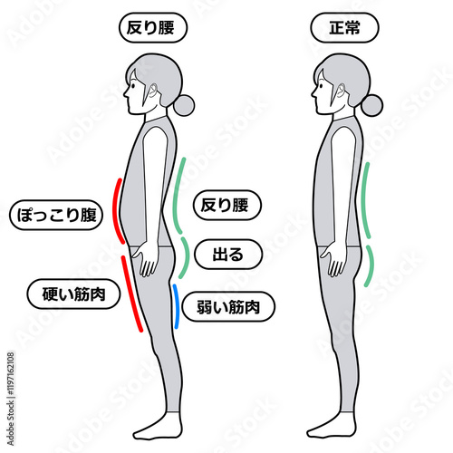 反り腰の状態