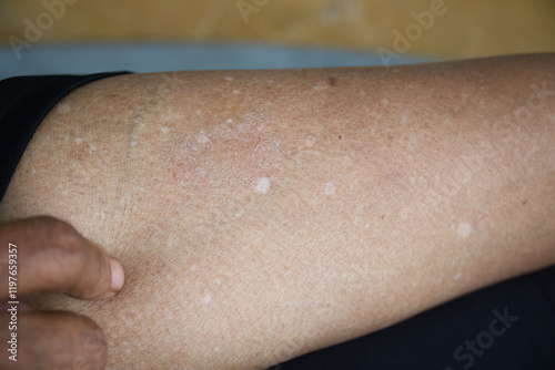 Idiopathic guttate hypomelanosis (IGH) is a common, harmless skin condition that causes small, flat, white spots on the skin. It's usually found on the arms, legs, and face of older people photo