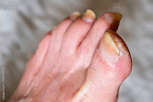 A close up of a person's foot with a fungus on it photo