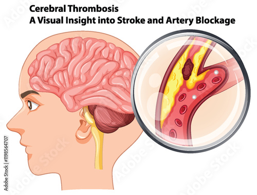 Understanding Cerebral Thrombosis and Stroke