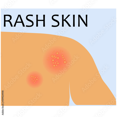 vector illustration of rash skin on body. Acne, allergy, dermatitis, eczema, skin irritation, itchy, dermatology. Isolated on white background