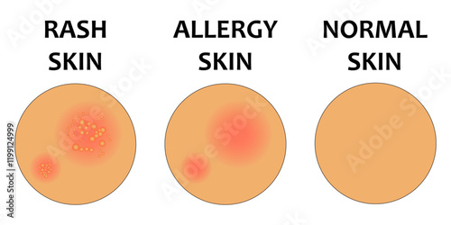 vector illustration of comparison of rash skin, allergy skin, normal skin. Acne, allergy, dermatitis, eczema, skin irritation, itchy, dermatology. Isolated on white background