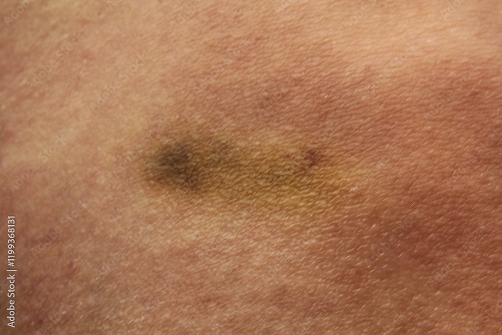 Fototapeta premium Close-up of bruise injury on skin. Wounded skin with hematoma. Bruised leg after home abuse. Bruise occuring as result age due to thinning of the skin. Inflammation knee from trauma. Medical problem