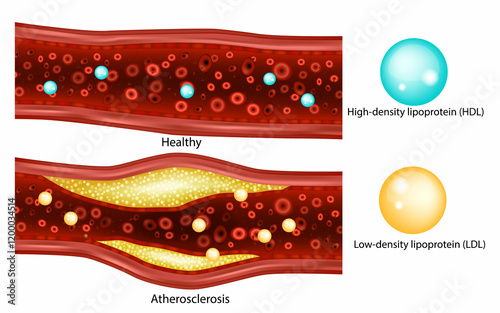 Cholesterol. Low-density lipoprotein (LDL)High-density lipoprotein (HDL). Atherosclerosis, arterial plaque 