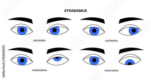 Strabismus eye disease