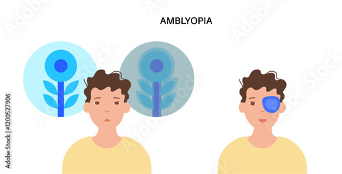 Amblyopia or lazy eye