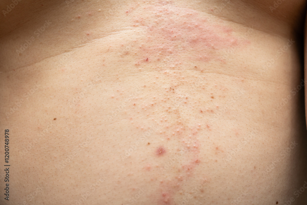 Fototapeta premium Atopic eczema on the stomach. Allergy, allergic reaction from atopic, hand in scratching itchy, itch red spot or rash of skin.