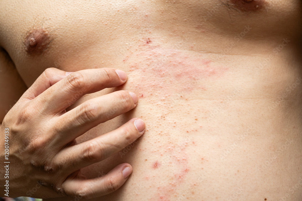 Fototapeta premium Atopic eczema on the stomach. Allergy, allergic reaction from atopic, hand in scratching itchy, itch red spot or rash of skin.