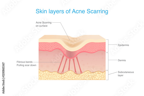 Skin layers of Acne scarring. Under scar in the dermis layer have fibrous bands pulling scar down. Anatomy of human facial skin with acne scar.