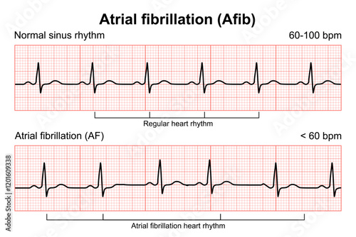 Atrial fibrillation (AFib) illustration Heart reading