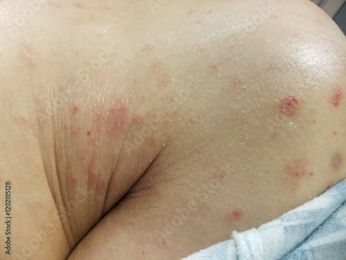 Scabies excoriated skin lesions - close-up view