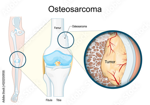 Osteosarcoma. Malignant bone tumor.