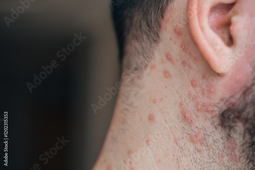 Adult man neck and body with strong aggressive varicella or chicken pox. Pink spots, papules, vesicles. photo