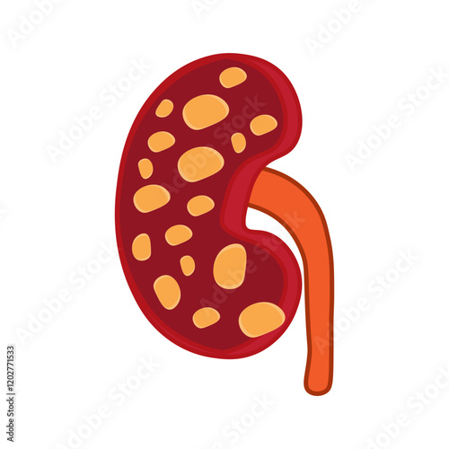 polycystic kidney