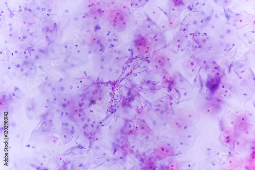 Φωτογραφία View in microscopic of Candidiasis, fungal infection (Yeast and Pseudohyphae form) in pap smear slide cytology and diagnostic by pathologist