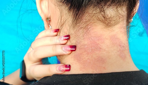 portrait the rash hives allergy and inflammation skin, reaction and urticaria, scar and freckles, urticaria stigma and eczema, epidermis blister rosacea on the neck, health care and medical concept.