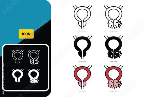 Normal prostate and benign pro-static hyperplasia. Bladder surgery urologist. Vector icon set photo