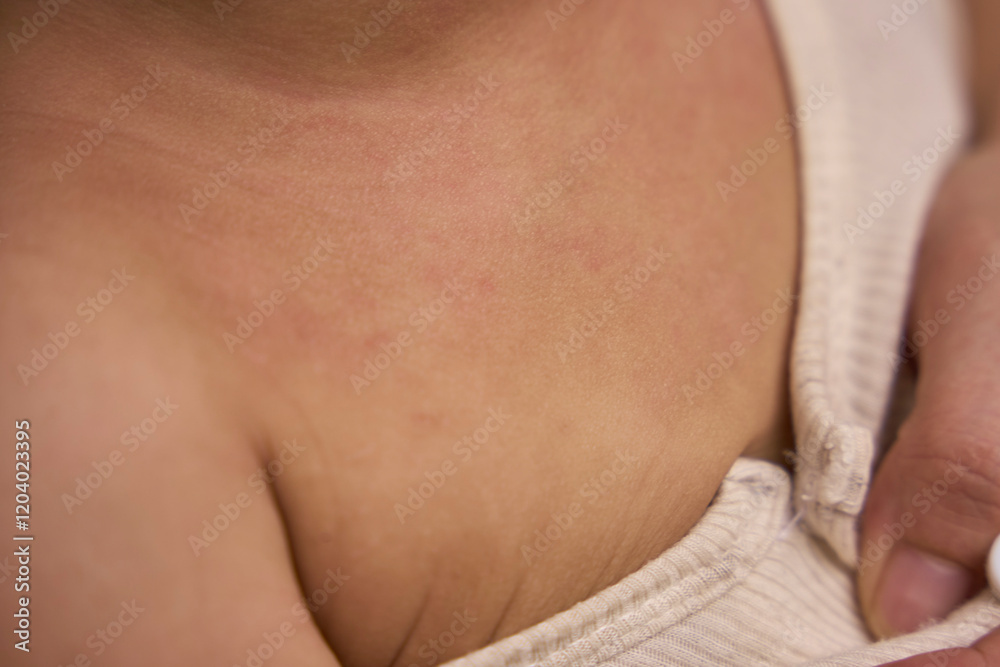 The baby has atopic eczema on the neck and chest The baby has atopic eczema on the neck and chest