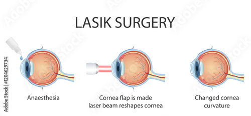 The process of laser eye surgery LASIK. Vision correction for nearsightedness, farsightedness, and astigmatism