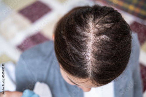 Top of the head of young Asian woman after facing hair loss problem. Need to take medicine like zinc and biotin to make her hair grow faster and thicker. Alopecia. photo