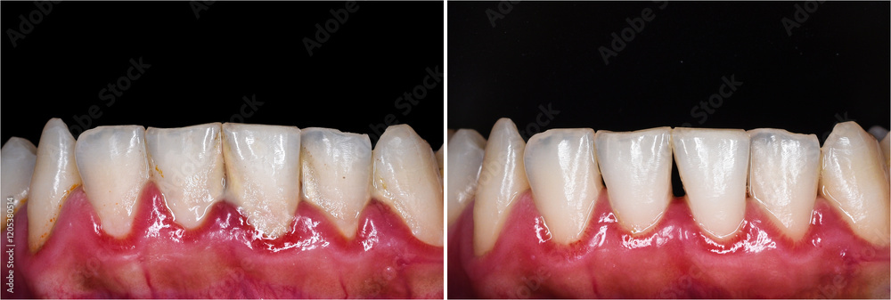 Εκτύπωση καμβά teeth tartar and calculus cleaning