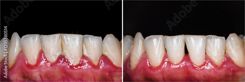 Εκτύπωση καμβά teeth tartar and calculus cleaning