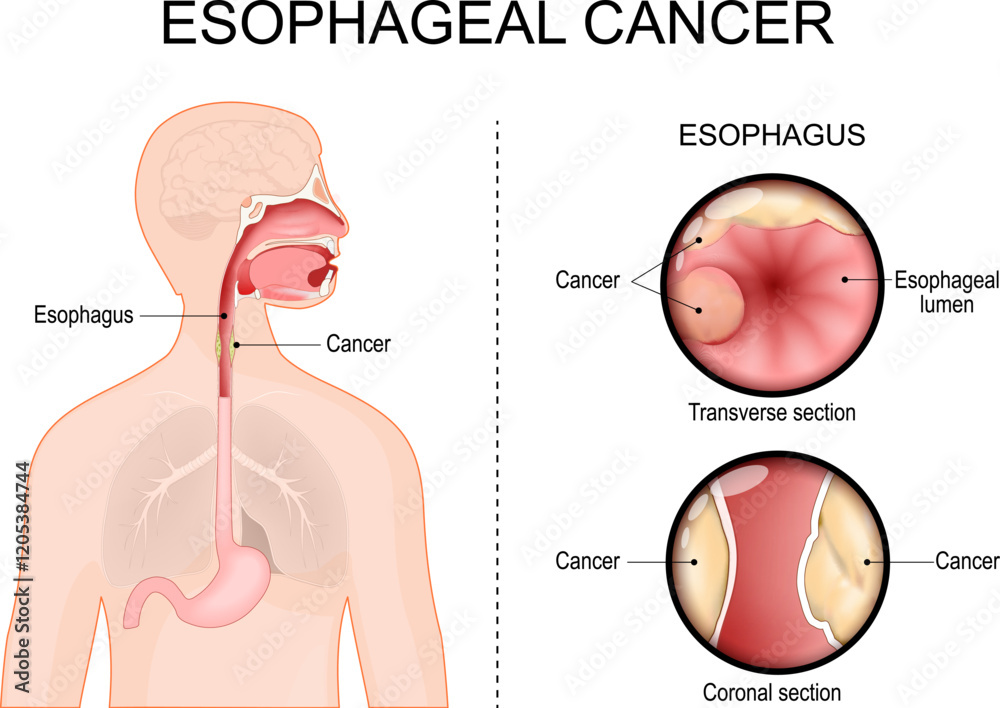 Obraz premium Esophageal cancer