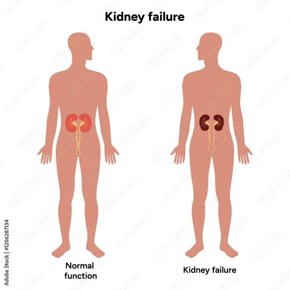 Fototapeta premium Kidney failure. Medical Kidney disease