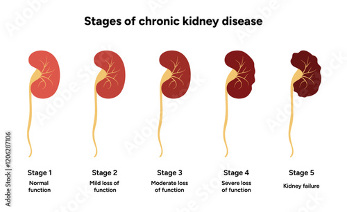 Stages of Kidney failure. Medical Kidney disease