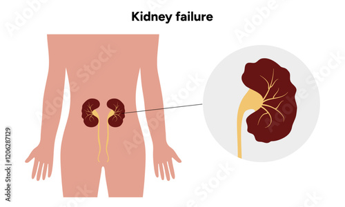 Kidney failure. Medical Kidney disease