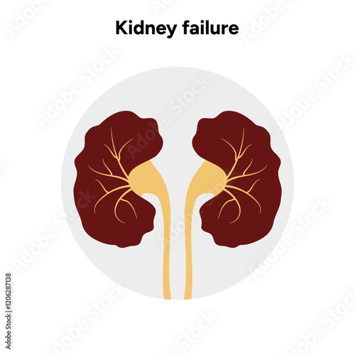 Kidney failure. Medical Kidney disease