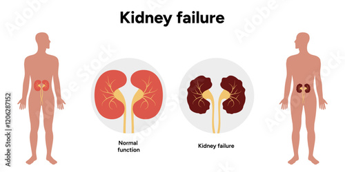 Stages of Kidney failure. Medical Kidney disease