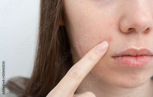 Close up of young woman pointing to a pimple on her cheek. Inflamed acne and post-acne marks and redness on face. Hormonal acne treatment, puberty and before menstruation, adult acne, rosacea.  photo