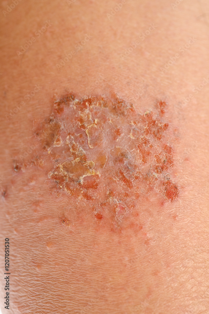 Fototapeta premium Close-up of cold urticaria on leg