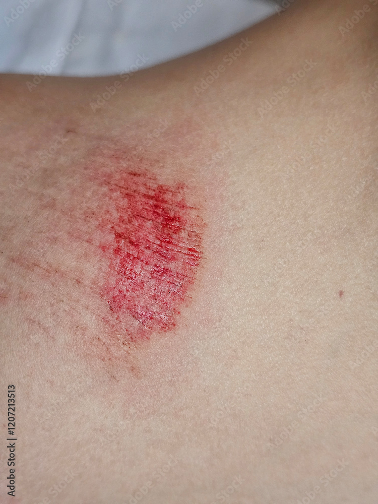 Fototapeta premium Injury with fresh blood on skin revealing a detailed view of abrasion on the body concept