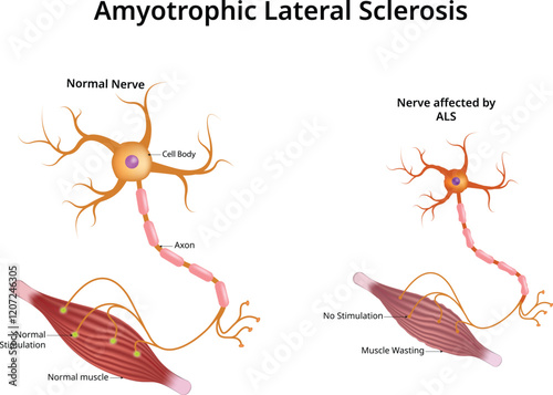 Amyotrophic Lateral Sclerosis Design Vector Illustration