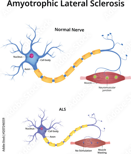 Amyotrophic Lateral Sclerosis Design Vector Illustration