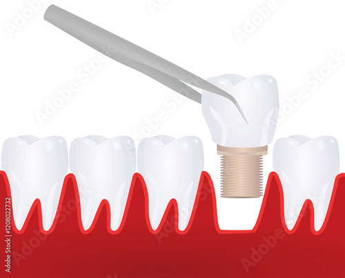 Tooth implant model. vector illustration