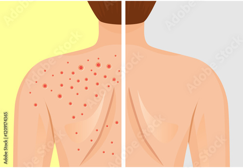 illustration of a body with acne before after. acne on the body vector