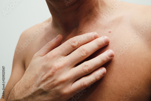 Man with red spot on chest, skin disease. Acne. Pimple. Man applying cream on chest. photo