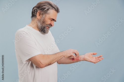 Senior man scratching itchy eczema on arm suffering from dermatitis