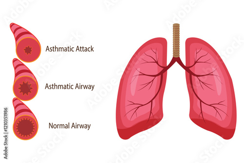 illustration of asthmatic airway,  medical illustration. vector eps 10